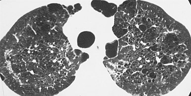 HRCT of cysts of pneumocystis pneumonia. These are usually multiple and bilateral, but range in size, shape and distribution.[7]