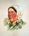 A lithograph from the Atlas depicting a woman with Lupus erythematosus.