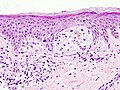 Melanoma in skin biopsy with H&E stain – this case may represent superficial spreading melanoma.