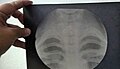 Historische X-Ray Glasplatte 24 × 30 cm – vermutlich Erster Weltkrieg – Torso einer Krankenschwester aus Deutschland