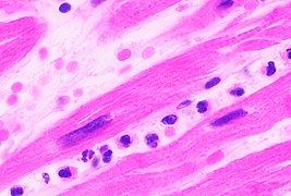 Neutrophils are seen in a myocardial infarction at approximately 12–24 hours,[62] as seen in this micrograph.