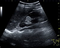 Figure 11. Angiomyolipoma seen as a hyperechoic mass in the upper pole of an adult kidney.[1]