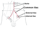 Iliac artery bifurcation and aorta