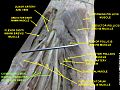 Common palmar digital branches of median nerve