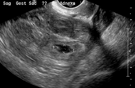 Ultrasound image showing an ectopic pregnancy where a gestational sac and fetus has been formed