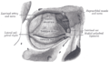 Anterior view of the orbit and tarsal plates. The lacrimal nerve can be seen exiting the orbit superolaterally after it supplies the lacrimal gland.