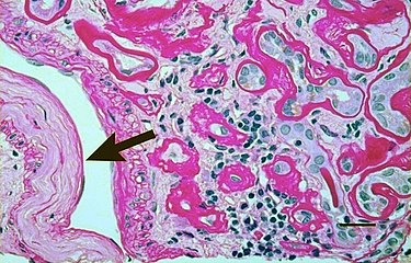 Light micrograph showing signs of hypertensive nephropathy: interstitial fibrosis, tubular atrophy with thickened tubular basement membranes, and fibrous intimal thickening of a small artery (arrow).