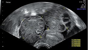 Ovarian hyperstimulation syndrome