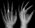 X-ray showing calcified enchondromas localized in finger a 37-year-old patient affected with Ollier disease