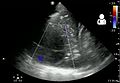 Pleural empyema as seen on ultrasound[14]