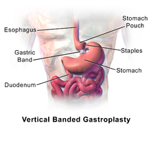 Vertical Banded Gastroplasty