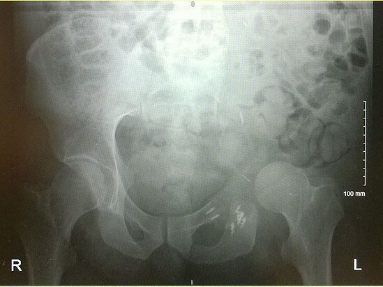 An x-ray of a limb-sparing hemipelvectomy on the left side of a male pelvis taken one month after surgery.
