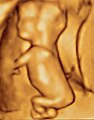 75-mm fetus (about 14 weeks' gestational age)
