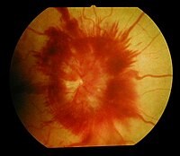 Optic disc edema and haemorrhage