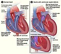 Figure A shows the structure and blood flow in the interior of a normal heart. Figure B shows two common locations for a ventricular septal defect. The defect allows oxygen-rich blood from the left ventricle to mix with oxygen-poor blood in the right ventricle.
