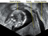 Retroverted uterus in pregnancy