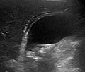 Abdominal ultrasonography showing gallstones, wall thickening and fluid around the gall bladder