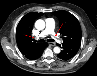 A computed tomography image depicting PE in the pulmonary arteries