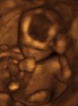 Fetus at 4+1⁄4 months
