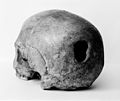 Edinburgh Skull, showing trepanning hole in back of skull