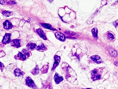 Micrograph of myxoid liposarcoma. H&E stain