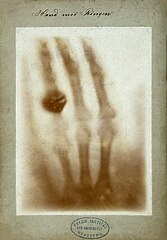X-ray by Wilhelm Röntgen