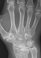 Rheumatoid arthritis with carpal ankylosis
