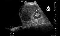 Ultrasound scan of the chest showing a left-sided hemothorax