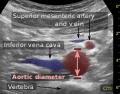 Aortic measurement on abdominal ultrasonography in the axial plane between the outer margins of the aortic wall[37]