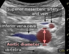Compression is used in this ultrasonograph to get closer to the abdominal aorta, making the superior mesenteric vein and the inferior vena cava look rather flat.