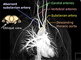 A 3D rendered magnetic resonance angiography, shown in an oblique projection in order to distinguish the aberrant subclavian artery