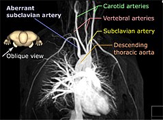 Aberrant subclavian artery Attribution-Share Alike 3.0 Unported license, attributed to Hellerhoff, Mikael Häggström and Anatomography