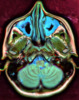 MRI image showing sinusitis. Edema and mucosal thickening appears in both maxillary sinuses.