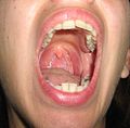 Open mouth with no visible palatine tonsils.