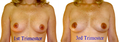 Image showing breast changes, proposed image Image 3