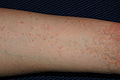 Scabies of the arm