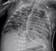 A chest radiograph showing bronchopulmonary dysplasia.