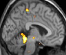 Diese Positronen-Emissions-Tomographie (PET) des Gehirns überlagert mit einer Kernspintomographie zeigt eine erhöhte Aktivität in der Schmerzmatrix und im Hypothalamus