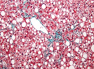 Micrograph of non-alcoholic fatty liver disease