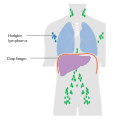 Stage 1 Hodgkin lymphoma