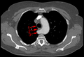 Typisches Bild einer Arteria lusoria in der Computertomographie. (1) Luftröhre, (2) Speiseröhre, dahinter (3) A. lusoria aus dem Aortenbogen entspringend.