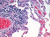 Lung tissue taken from an emphysema patient. Cell nuclei (blue-purple), red blood cells (bright red), other cell bodies and extracellular material (pink), and air spaces (white).