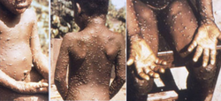 An image of the rash of monkeypox