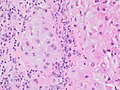 Histopathology of a metastatic melanoma to a lymph node, H&E stain, showing poorly differentiated cells