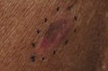 Malignant melanoma, left mid-back marked for biopsy
