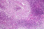 Pulmonary tuberculosis featuring necrotizing granulomas, H&E stain.