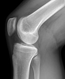Röntgenbild eines rechten Kniegelenkes (Ansicht von der medialen Seite)