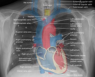 Mediastinal structures on chest X-ray Attribution-Share Alike 3.0 Unported license, attributed to Mikael Häggström, ZooFari, Stillwaterising and Gray's Anatomy creators