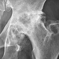 Severe hip osteoarthritis