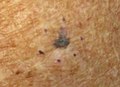 Melanoma, left forearm marked for biopsy